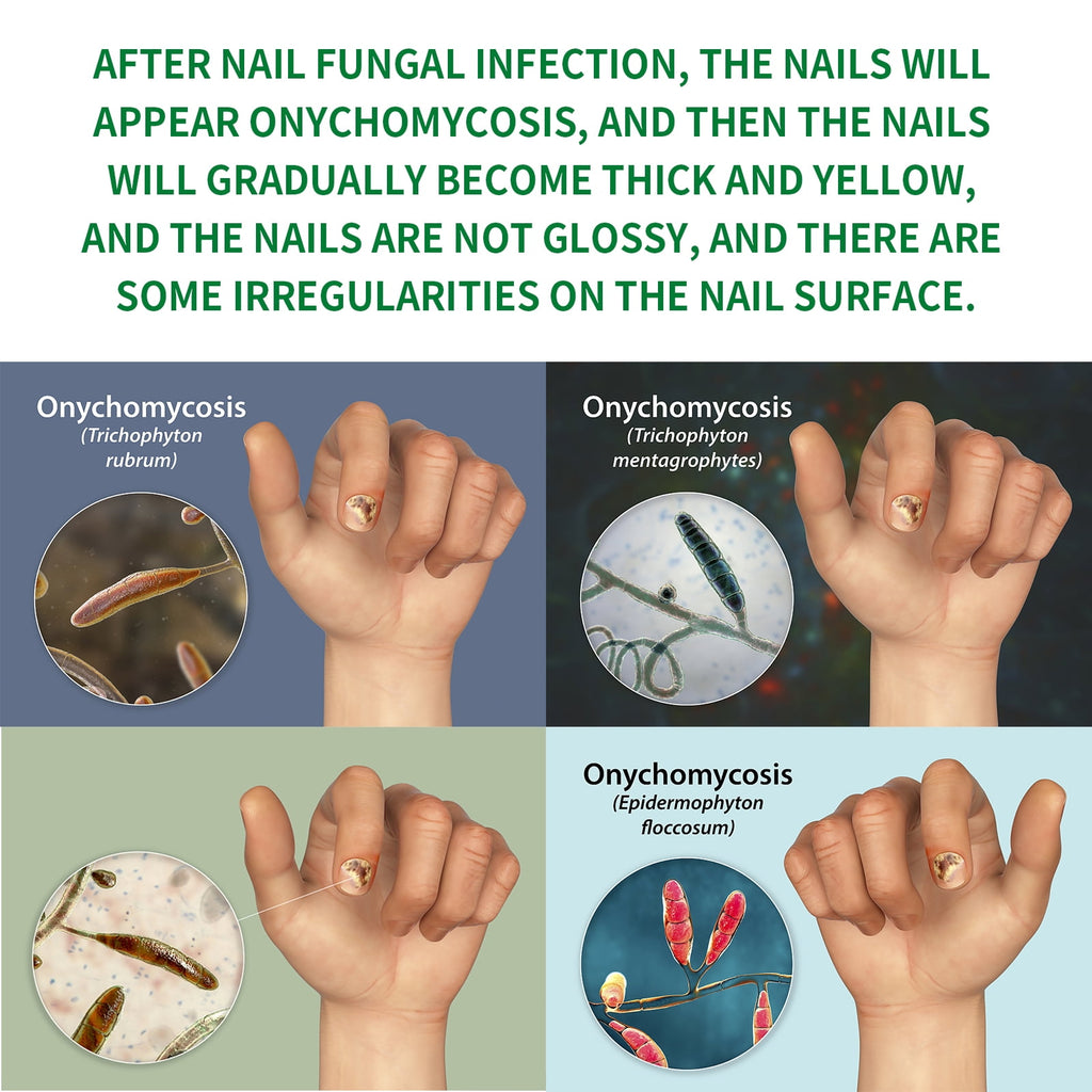 2pc 7-Day Toenail Fungus Treatment – Extra Strength Nail Repair for Discoloration &amp; Health (30 ML)