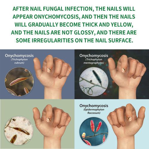 2pc 7-Day Toenail Fungus Treatment – Extra Strength Nail Repair for Discoloration &amp; Health (30 ML)