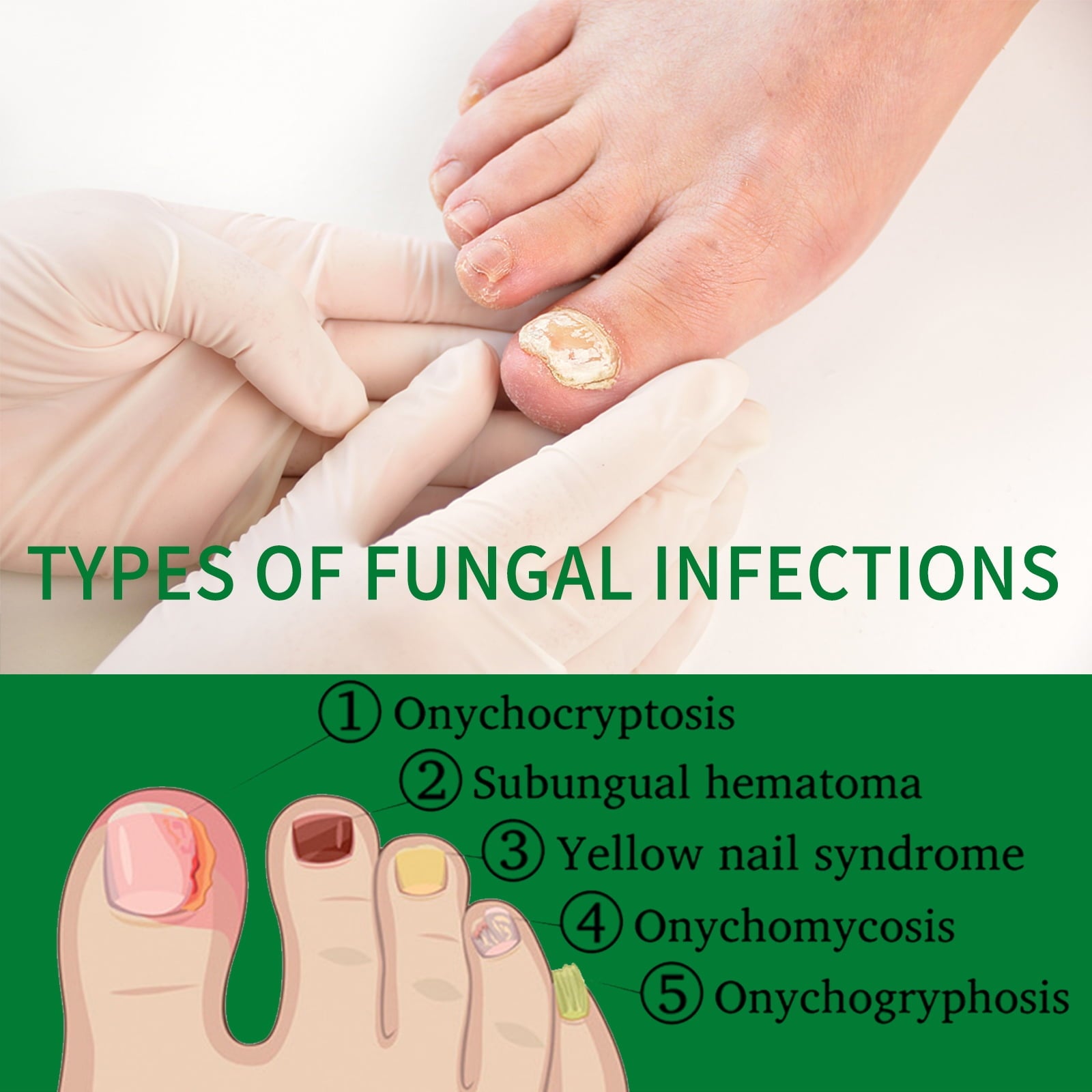 2pc 7-Day Toenail Fungus Treatment – Extra Strength Nail Repair for Discoloration &amp; Health (30 ML)