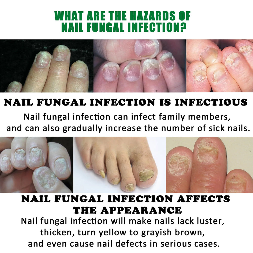 2pc 7-Day Toenail Fungus Treatment – Extra Strength Nail Repair for Discoloration &amp; Health (30 ML)