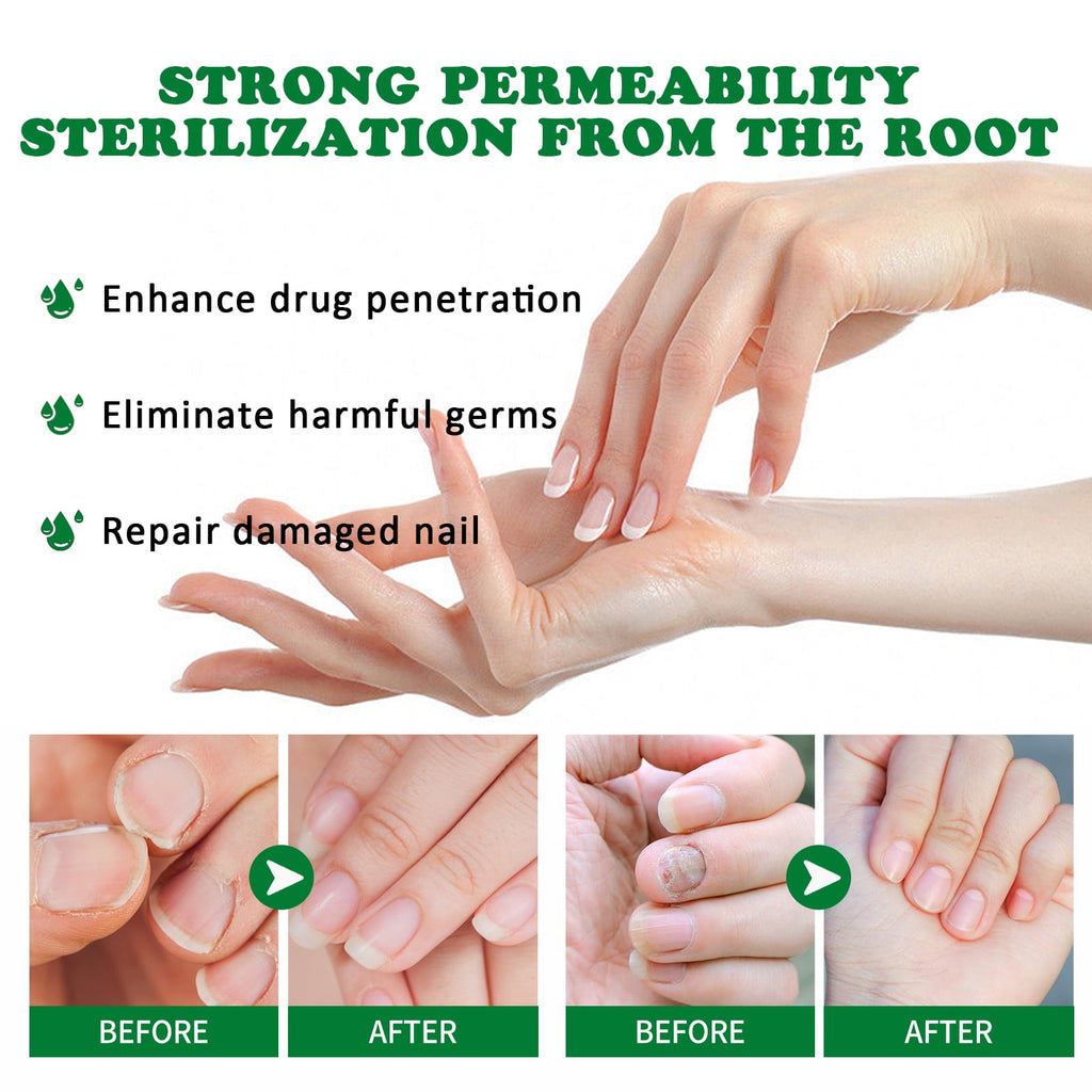 2pc 7-Day Toenail Fungus Treatment – Extra Strength Nail Repair for Discoloration &amp; Health (30 ML)